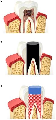 Platelet-Rich Plasma and Platelet-Rich Fibrin Can Induce Apical Closure More Frequently Than Blood-Clot Revascularization for the Regeneration of Immature Permanent Teeth: A Meta-Analysis of Clinical Efficacy